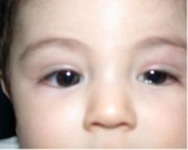 Bebeklerde Kornea Çizilmesi Tedavisi Bebeklerde Kornea Çizilmesi Tedavisi