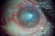 Kornea Apsesi Belirtileri ve Tedavisi Kornea Apsesi Belirtileri ve Tedavisi